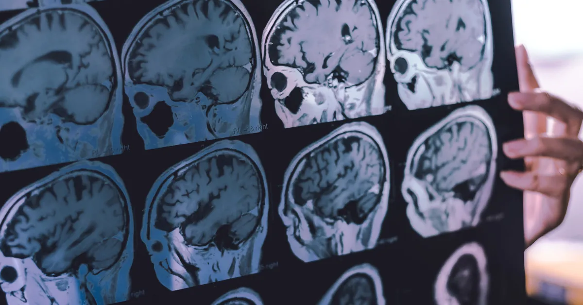 A hand holding up a sheet of printed film that shows the results of an MRI scan of the frontal lobe in the brain.